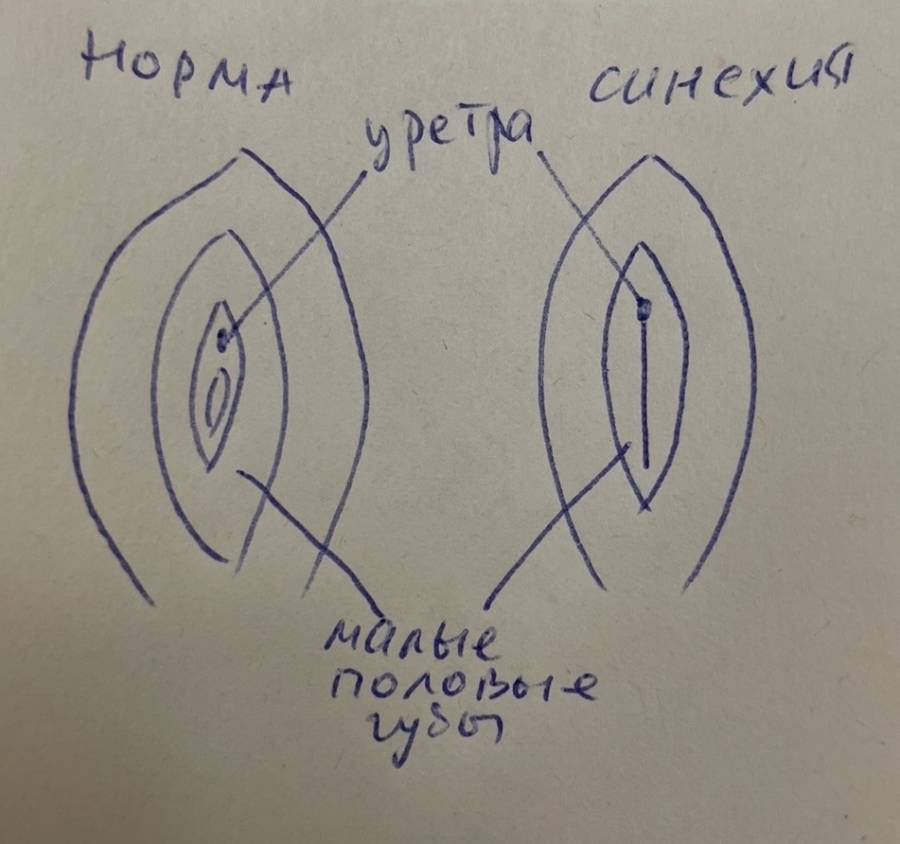 Синехии малых половых губ у девочек. Лихен вульвы. Бережное лечение
