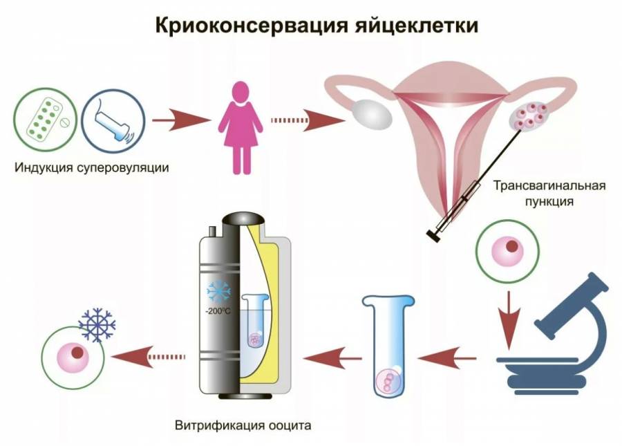 Заморозка яйцеклеток