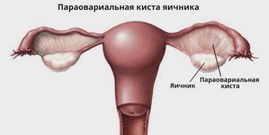 Параовариальная киста. Тактика ведения. Онкомаркеры. Случай из практики